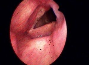 声带闭合不佳恢复指南_原因与治疗方法