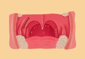 咽喉肿物手术必要性及治疗选择详解
