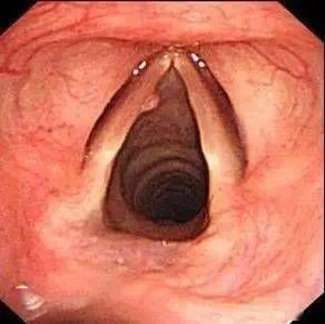 声带术后嘶哑恢复_常见原因与应对攻略