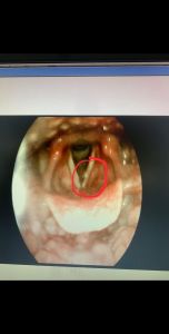 声带息肉症状识别_常见表现与早期治疗
