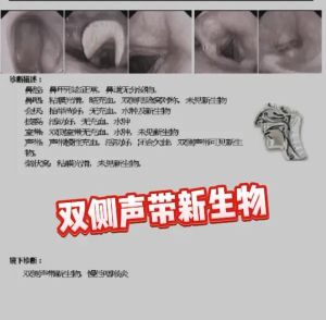 声带手术_声音再生与恢复之道