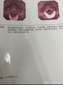 喉咙沙哑恢复时间及应对策略