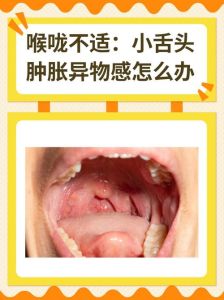 腭垂肿大吞咽不适_揭秘成因与预防攻略