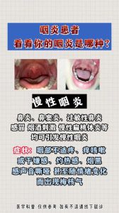 咽炎隐秘原因大，告别咽炎困扰！