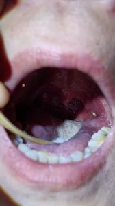 喉咙沙粒感？别大意，多喝水去医院看看！